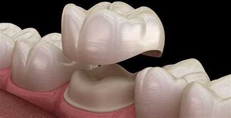 All Ceramic Crowns – Dr. Vahe Karimian