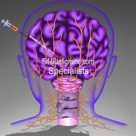 Local Anaesthetic Versus Steroid In Greater Occipital - vrogue.co