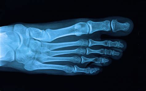 Xray Of Foot With Arthritis