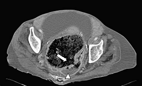 Imaging manifestations of faecal impaction and stercoral perforation - Clinical Radiology