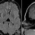 Radiology MRI: Neonatal Intraventricular Hemorrhage