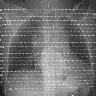 CT scan of the patient discloses the widening of mediastinum and left ...