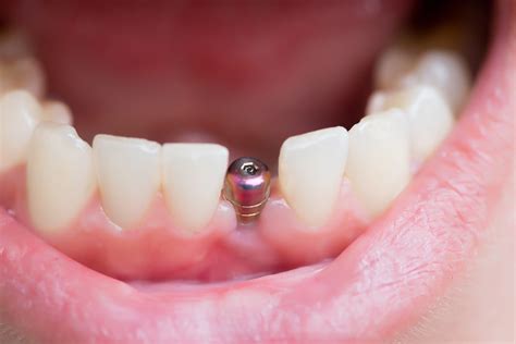 Can Dental Implants Get Infected? | Central Periodontics