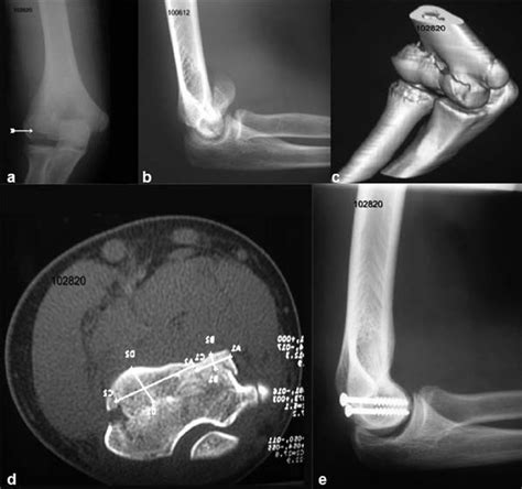 (a) Anteroposterior view of the elbow showing the fracture (white ...