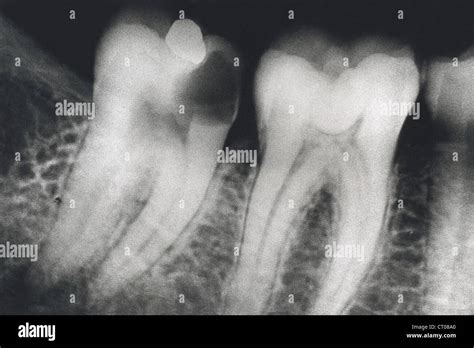 Tooth Cavity Xray