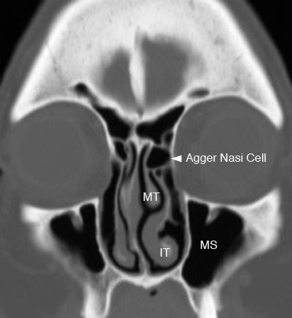 Ethmoid Sinus: Normal Anatomy & Variants