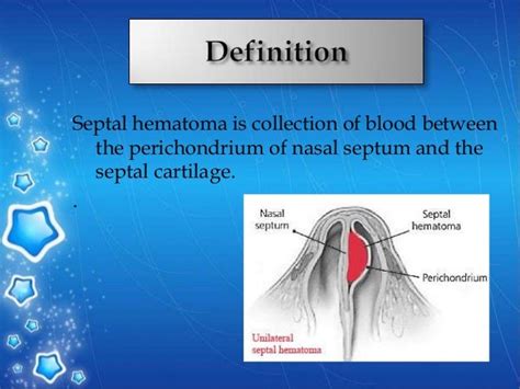 Septal Hematoma Drainage