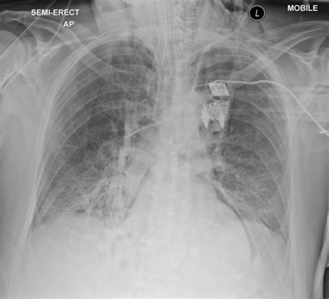 Pneumopericardium : BC Emergency Medicine Network