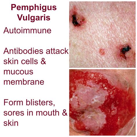 Life Threatening Skin Rash series - Pemphigus Vulgaris - Eczema Blues