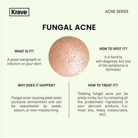 Fungal acne | Skin facts, Skin care acne, Skin advice