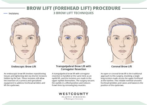 Brow Lift in St. Louis Missouri | West County Plastic Surgeons