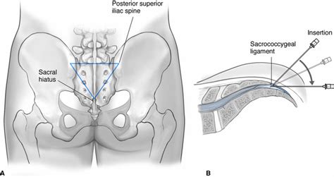 Caudal Anesthesia Technique