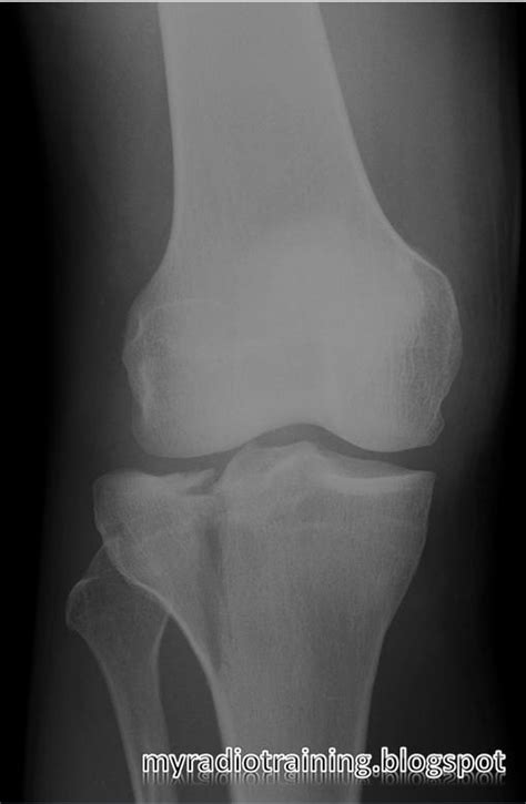 Radiology info hub: Proximal tibial fracture - Schatzker Classification