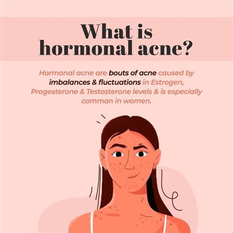 Hormonal Acne: The What, Why and the Remedy – Sublime Life | Hormonal ...