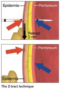 Paracentesis Complications – POCUS Pro and Proceduralist.org