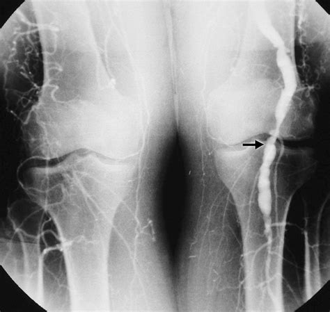 Popliteal Artery Disease: Diagnosis and Treatment | RadioGraphics