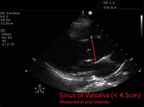 Aortic Dissection Ultrasound