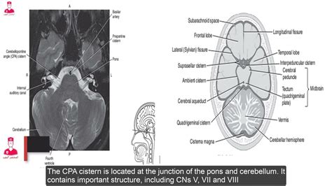 Quadrigeminal Cistern Anatomy