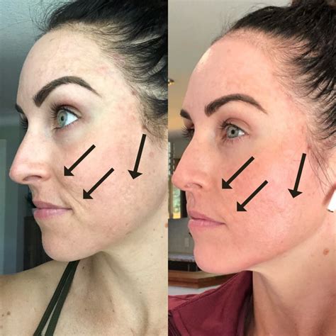 My Experience w/ Microneedling & Why I'm Obsessed - PaleOMG