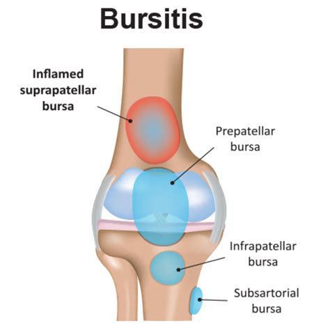 Bursitis Knee Pain - Carolinas Pain Center - Pain Relief Options