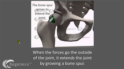 Hip Bone Spur Removal - Why You Should Avoid It - Regenexx®