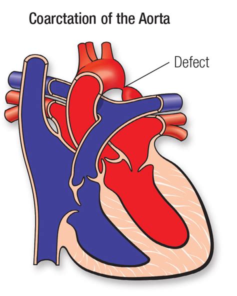 Coarctation de L'aorte (CoA) | Kompremos