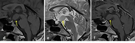 Hypothalamic hamartoma – Radiology Cases