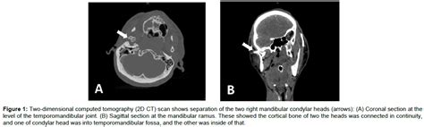 The Mandibular Fossa