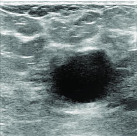 An ultrasound image of breast cyst. | Download Scientific Diagram