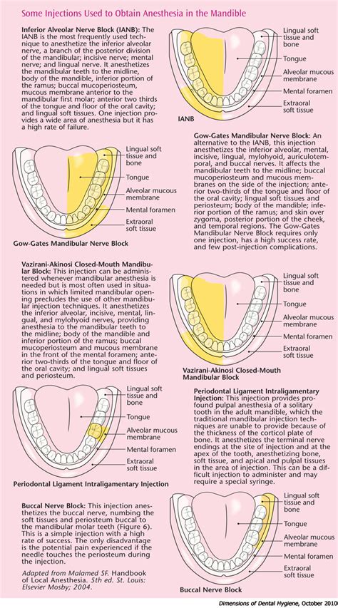 Achieve Anesthesia Success in the Mandible - Dimensions of Dental Hygiene