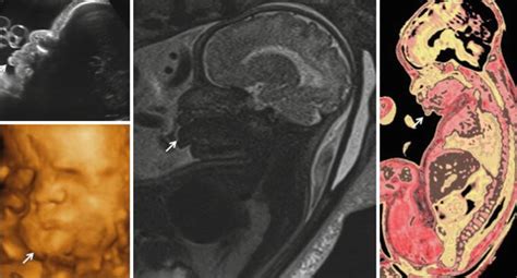 Prenatal Diagnosis of Beckwith-Wiedemann Syndrome Using 3D Ultrasound and Fetal MRI | Radiology Key