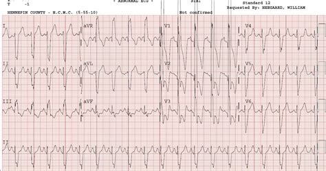 Dr. Smith's ECG Blog: Severe Right Ventricular Hypertrophy