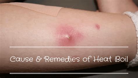 Heat Boil - Causes, Symptoms and Easy Home Remedies - Food N Health