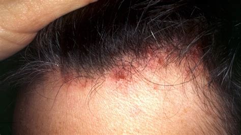 Scalp folliculitis: Symptoms, pictures, causes, shampoos and creams