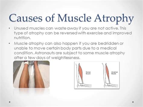 Muscle Atrophy - YouTube