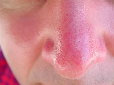 The Biological Mechanism Of Sunburn