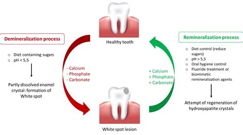 Dental Caries Process