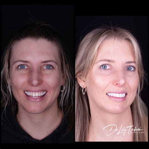 Composite Veneers Perth | Dental Veneers Cost | Connolly Dental