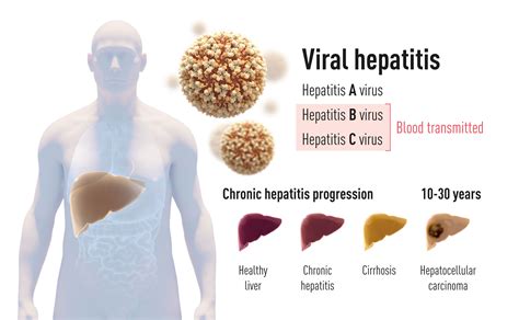 Hepatitis