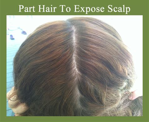 Natural Scalp Psoriasis Treatment With Tea Tree Oil and Olive Oil - HubPages