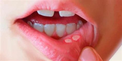 Cómo tratar las aftas bucales | Badía Clínica Dental