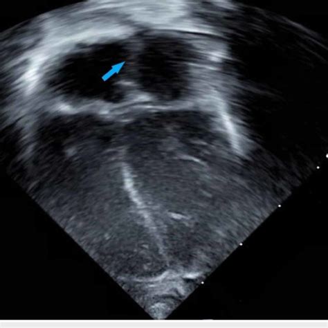 Echocardiogram apical four-chamber view showing a patent foramen ovale... | Download Scientific ...