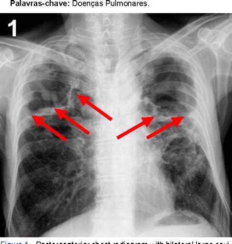 Figure 1 from Cavitary lung lesions. | Semantic Scholar