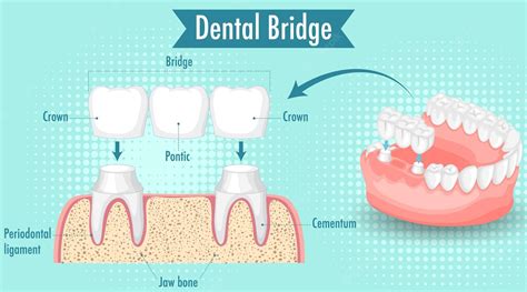What are dental bridges? - Royal Dental Clinics Blog