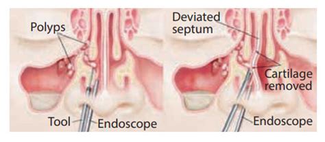 Functional Endoscopic Sinus Surgery (FESS): Procedure, 55% OFF