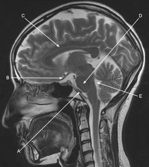 Magnetic resonance imaging of the sagittal structures in the brain | The BMJ