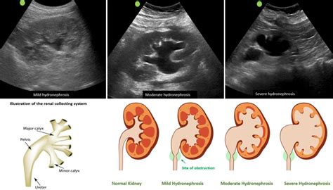 The Ultrasound Mimics of Hydronephrosis - Renal Fellow Network