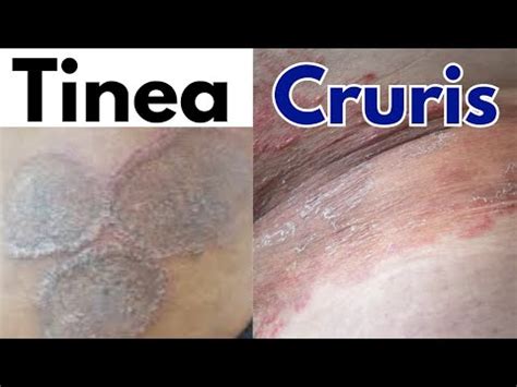 Tinea Cruris jock itch | Tinea cruris symptoms, treatment | Jock itch ...