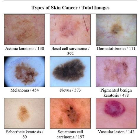 Image sample of skin tumor types used in this study and the number of... | Download Scientific ...