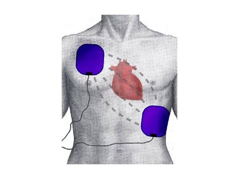 Correct AED Pad Placement – First aid for free